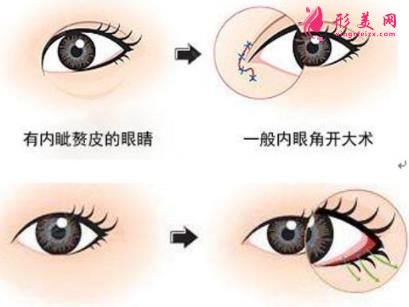 徐州醫(yī)院雙眼皮做得好嗎？案例效果分享_眼部修復(fù)干貨盤點(diǎn)