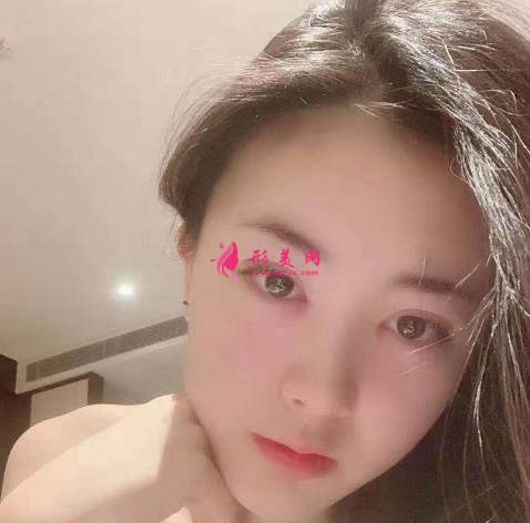 哈醫(yī)大一院美容科雙眼皮怎么樣？恢復(fù)效果分享_手術(shù)后如何護(hù)理?