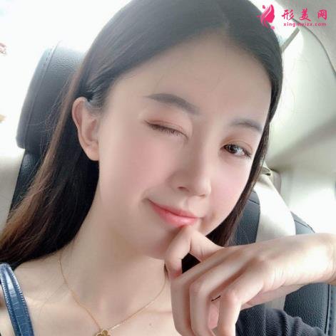 哈醫(yī)大一院美容科雙眼皮怎么樣？恢復(fù)效果分享_手術(shù)后如何護(hù)理?