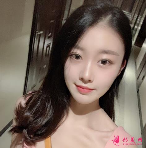 哈醫(yī)大一院美容科雙眼皮怎么樣？恢復(fù)效果分享_手術(shù)后如何護(hù)理?