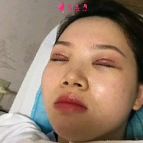 天津公安醫(yī)院雙眼皮怎么樣？哪些人不能做雙眼皮手術(shù)？