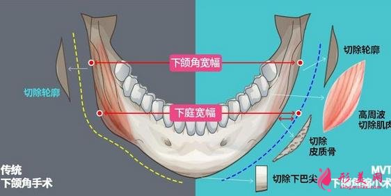 上海九院下頜角磨骨怎么樣？特色技術(shù)分析和案例效果圖匯總！你評評效果如何