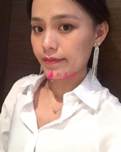 福州海峽美容醫(yī)院去眼袋怎么樣？技術(shù)特色、案例、價(jià)格收費(fèi)雙雙公開(kāi)