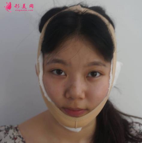 上海九院下頜角磨骨怎么樣？特色技術(shù)分析和案例效果圖匯總！你評評效果如何