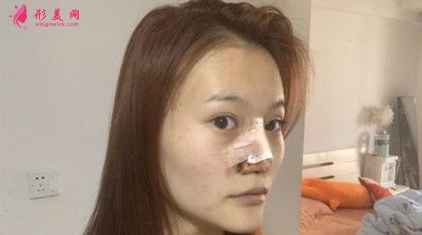 浙一醫(yī)院鼻綜合手術(shù)案例分享!鼻翼縮小術(shù)價格是多少錢?