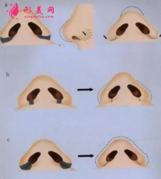 西京醫(yī)院鼻綜合怎么樣？鼻孔不對稱怎么辦？手術(shù)矯正詳解