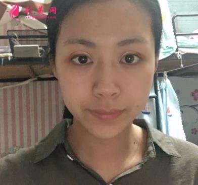 廣州曙光醫(yī)院做雙眼皮手術(shù)怎么樣？多少錢？眼整形案例及費用價格查詢