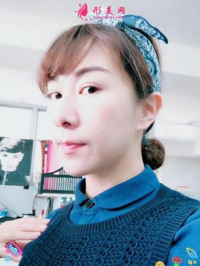 蘭州市第二人民醫(yī)院整形科全切雙眼皮案例效果分享！前后變化太贊了