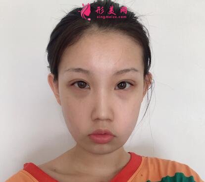 成都八大處整形醫(yī)院隆鼻案例曝光！還有價(jià)格收費(fèi)明細(xì)參考