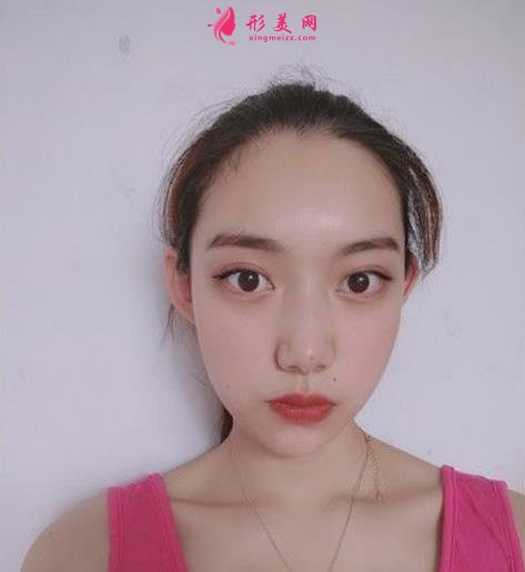 北京純脂孫澤芳面部填充脂肪案例反饋!整形價(jià)格全面一覽