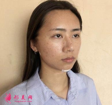浙江普陀醫(yī)院整形外科面部吸脂怎么樣？真人案例及2021價格表公開