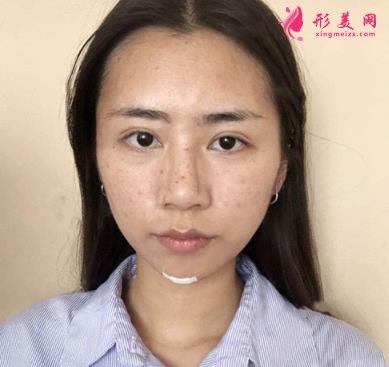 浙江普陀醫(yī)院整形外科面部吸脂怎么樣？真人案例及2021價格表公開