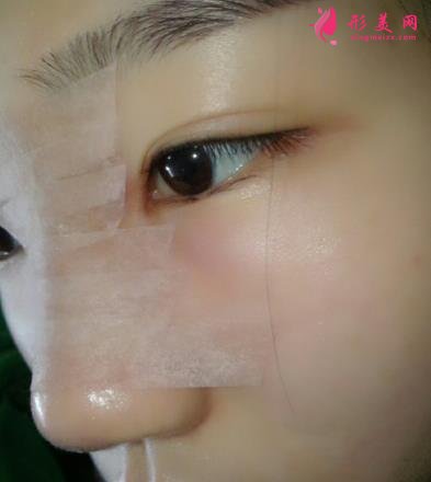 金華永康光大醫(yī)療美容隆鼻怎么樣？案例效果圖和價格價目表同步分享