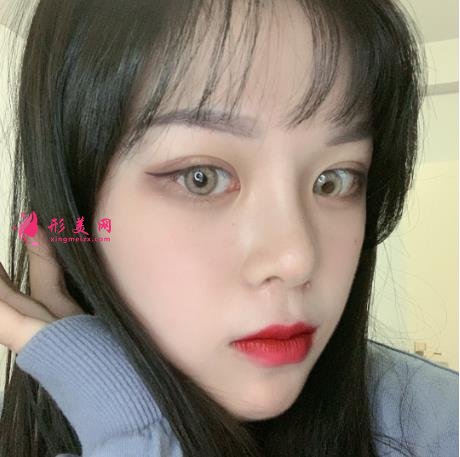 深圳北大醫(yī)院整形外科做全切雙眼皮怎么樣？附案例實拍反饋及價格表