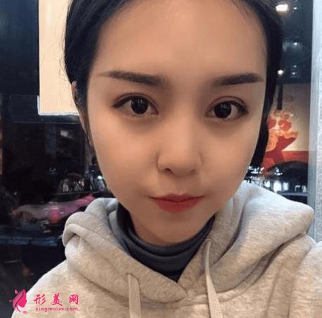 西安西京醫(yī)院雙眼皮怎么樣？為什么開內(nèi)眼角手術(shù)后眼角縮回？