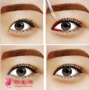 西安西京醫(yī)院雙眼皮怎么樣？為什么開內(nèi)眼角手術(shù)后眼角縮回？