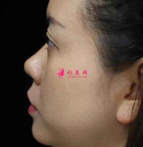 浙醫(yī)二院整形科做熱瑪吉怎么樣？專家案例、價格表清單一一盡顯！