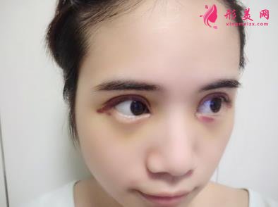 洛陽三院美容科做雙眼皮怎么樣？真實案例恢復圖及價目價格全面了解