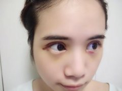 洛陽三院美容科做雙眼皮怎么樣？真實案例恢復(fù)圖及價目價格全面了解