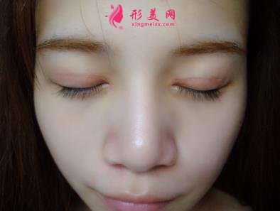 洛陽三院美容科做雙眼皮怎么樣？真實案例恢復圖及價目價格全面了解
