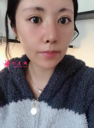 成都新麗美整形醫(yī)院隆鼻怎么樣？口碑案例和正規(guī)費(fèi)用（價(jià)格表）一覽