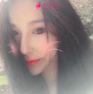 杭州整形醫(yī)院(杭州手外科醫(yī)院）做隆鼻怎么樣？專家案例及價(jià)格價(jià)錢表反饋