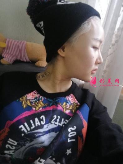 成都潤(rùn)美玉之光整形怎么樣？自體脂肪全臉填充案例和真實(shí)價(jià)格價(jià)目分享