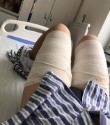 南醫(yī)大友誼整形醫(yī)院吸脂案例效果價格收費標準同步一覽