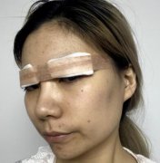 北京協(xié)和整形醫(yī)院雙眼皮案例_價格(價目)表請查收~