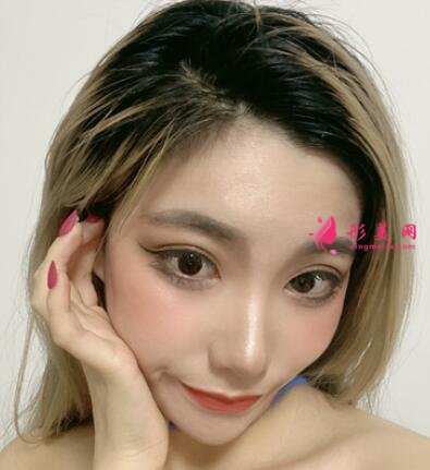 北京協(xié)和整形醫(yī)院雙眼皮案例_價格(價目)表請查收~