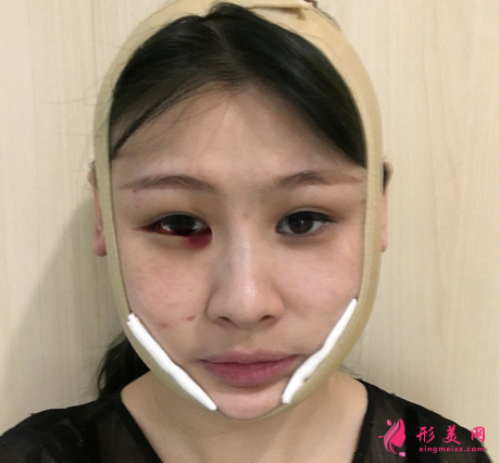 佛山禪城中心醫(yī)院整形磨骨咋樣？案例效果反饋_整形價(jià)格同步一覽