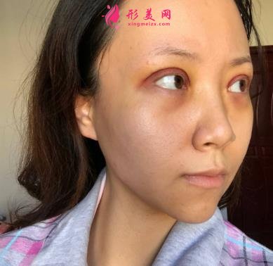 天津公安醫(yī)院雙眼皮怎么樣？手術(shù)恢復過程分享_價格在線查詢