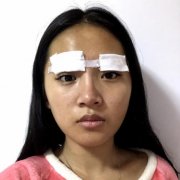 北京協(xié)和醫(yī)院雙眼皮多少錢？真人效果術(shù)后圖、價(jià)格表清單一一公布