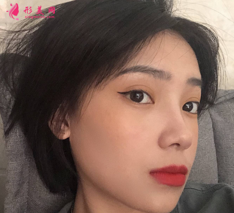 遵義醫(yī)學(xué)院整形外科雙眼皮案例口碑評價(jià)出爐！全新醫(yī)美價(jià)格表供參考~