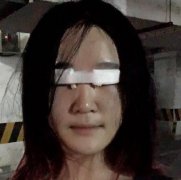 華西整形醫(yī)院做雙眼皮好不好？看專家案例和價(jià)格表為你們揭曉！