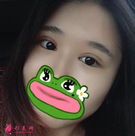 華西整形醫(yī)院做雙眼皮好不好？看專家案例和價(jià)格表為你們揭曉！