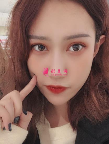 上海伊萊美醫(yī)療美容醫(yī)院做雙眼皮怎么樣？案例真實反饋_整形價格一覽