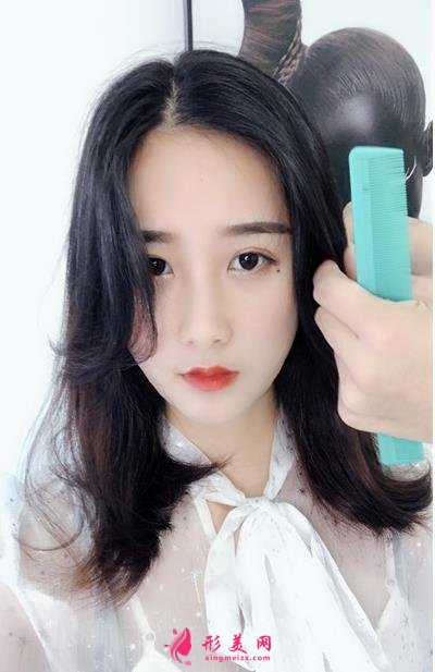 無錫曼陀羅醫(yī)院上臉下垂矯正案例_整形美容價格表請查收！