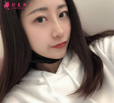 深圳美萊整形美容醫(yī)院隆鼻案例反饋如下~還有價(jià)格收費(fèi)表明細(xì)參考
