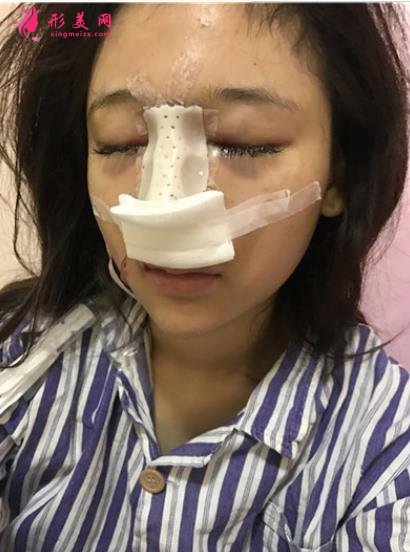 佛山華美整形醫(yī)院隆鼻做的咋樣？案例效果價格（價目）表供參考