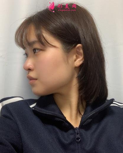 上海伊萊美李湘原做下頜角怎么樣?真人案例術(shù)后三個月效果展示