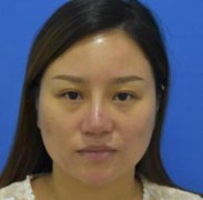 南昌大學(xué)二附院整形科去眼袋怎么樣？對(duì)比下真人案例及價(jià)格均價(jià)表
