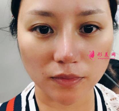 南昌大學(xué)二附院整形科去眼袋怎么樣？對(duì)比下真人案例及價(jià)格均價(jià)表