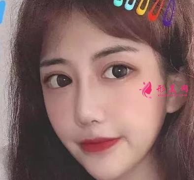 常州一院整形科做鼻子價(jià)格表2021！在分享真實(shí)案例效果圖
