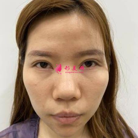 寧波六院隆鼻怎么樣？手術多少錢？真實恢復效果圖分享