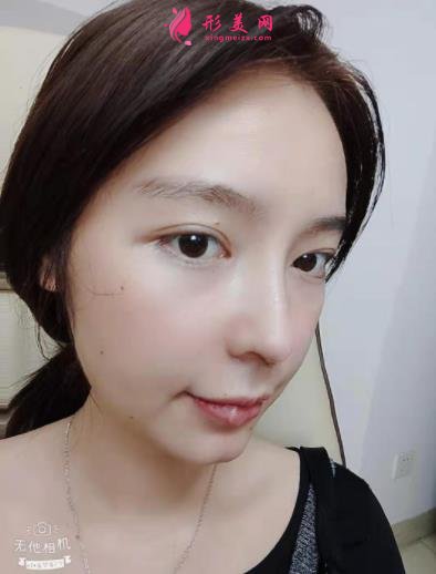2021上海九院戴傳昌做鼻子價格表!在對比真人隆鼻案例實拍