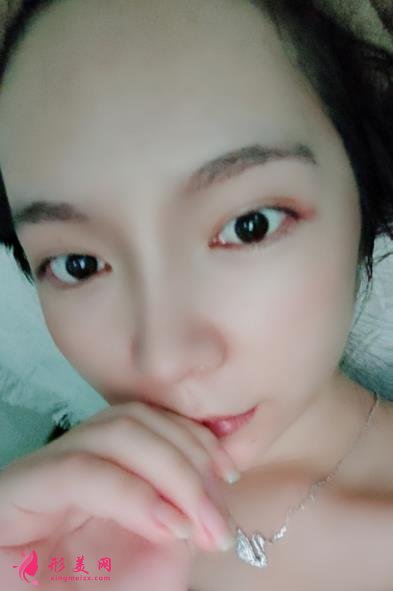 2021上海九院戴傳昌做鼻子價格表!在對比真人隆鼻案例實拍