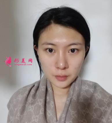 深圳陽光整形醫(yī)院雙眼皮怎么樣？效果好嗎？手術(shù)真實(shí)價(jià)格費(fèi)用參考