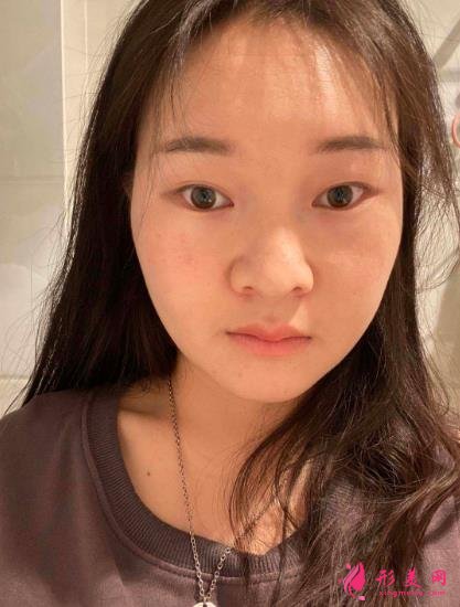 西安國際醫(yī)學中心整形醫(yī)院怎么樣？下頜角削骨案例及價格表2021均價一覽