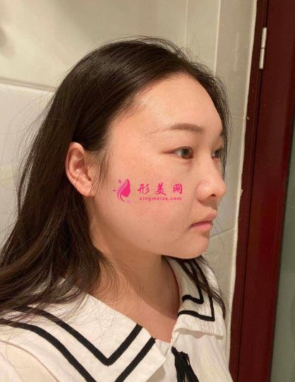 西安國際醫(yī)學中心整形醫(yī)院怎么樣？下頜角削骨案例及價格表2021均價一覽